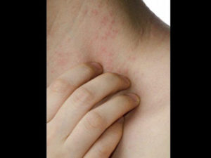 Lee más sobre el artículo SARPULLIDO o DERMATITIS, causa emocional que lo origina