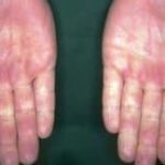 Origen emocional de la ESCLERODERMIA