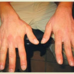 Origen emocional del ECZEMA (contacto o separación)