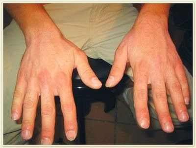Lee más sobre el artículo Origen emocional del ECZEMA