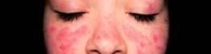 Lee más sobre el artículo Origen emocional del LUPUS eritematoso sistémico