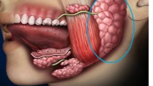 Lee más sobre el artículo Origen emocional de las PAPERAS