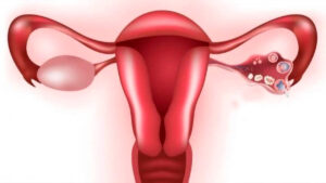 Lee más sobre el artículo Causas emocionales del OVARIO POLIQUÍSTICO