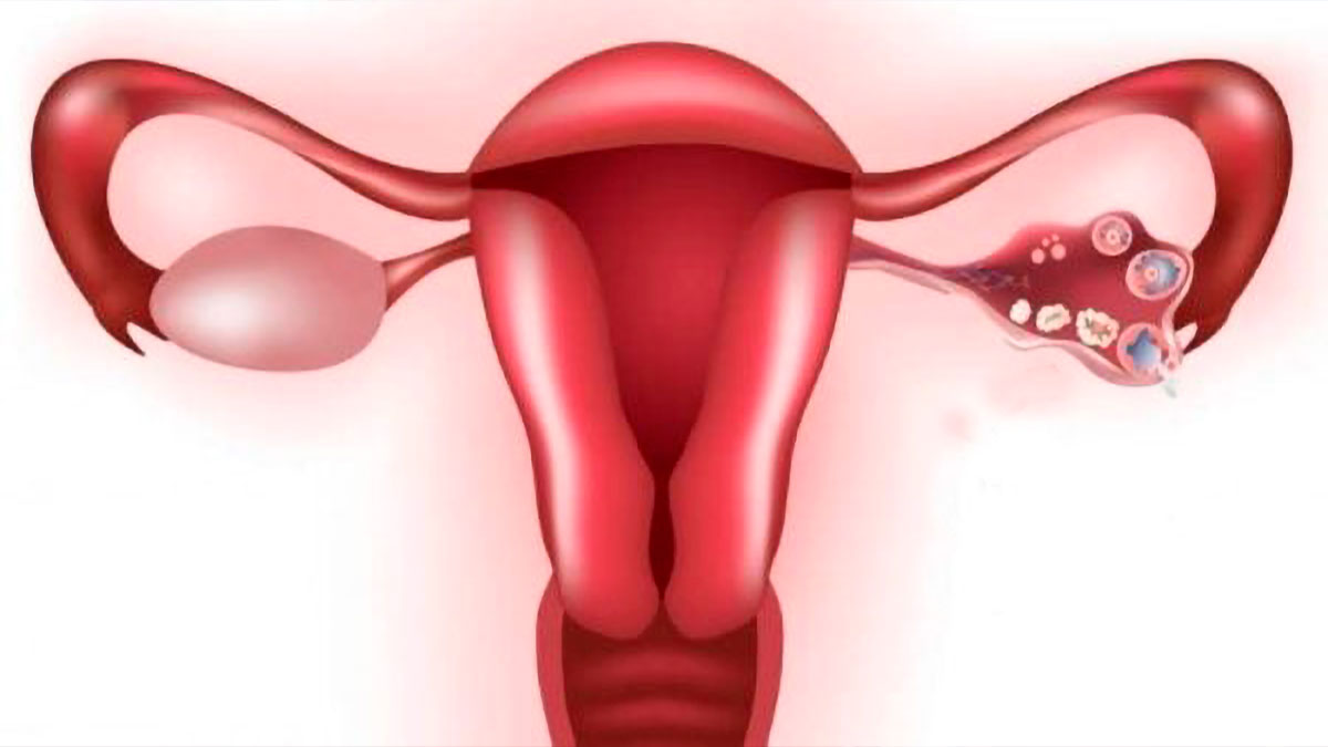 Lee más sobre el artículo Causas emocionales del OVARIO POLIQUÍSTICO