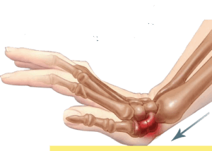 Lee más sobre el artículo ESCAFOIDES, conflictos emocionales que le afectan