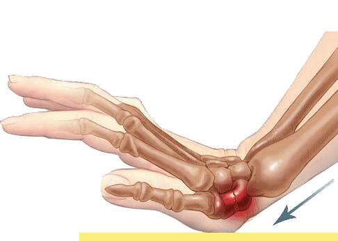 Lee más sobre el artículo ESCAFOIDES, conflictos emocionales que le afectan
